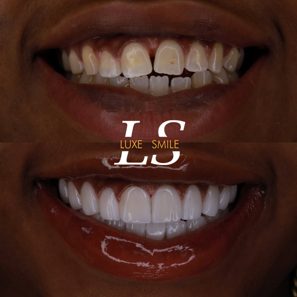Transformation 04 — before and after
